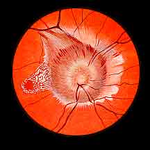 EYE 6